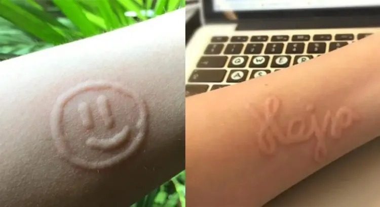 Rara enfermedad le permite “dibujar” sobre su piel